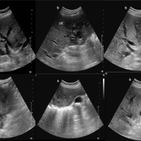 adenoma-51