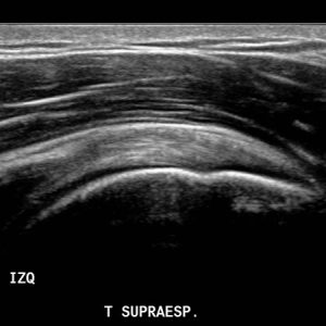 infopacientes_examen_musculoesqueletico_ecotomografia_codoizquierdo_3